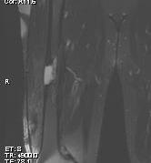 Chronic Ostetomyelitis Femur MRI Coronal